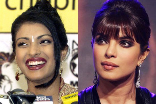 Bollywood Actresses With Plastic Surgery Before And After